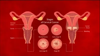 stages of cervical cancer